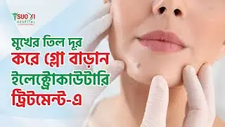 Birthmark Removal Treatment By Q-Switched Laser in Dhaka