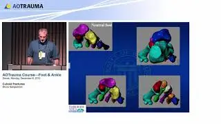 Cuboid fractures - Foot and Ankle