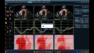 5540 LVAUTO2DS GME GMI, MYOCARIAL WORK INDEX EFFICIENCY, ECHOPAC ANALYSIS, LEFT VENTRICLE,R202