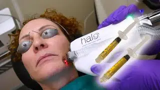 Adding PRF to Laser Treatment
