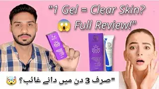 Acne Gel Honest Review | Real Results in Just Days! #skincare #duet #beauty 