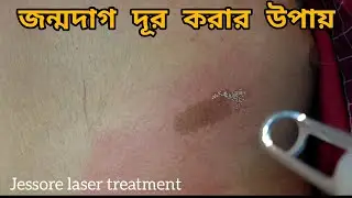 জন্মদাগ রিমুভ করার উপায় / Birthmark removal / laser treatment / @LaserSkinCareJessore