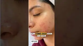 Why Your Acne Is Not Going Away