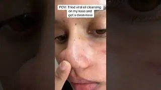 Cleansing oil did it&rsquo;s job😌 #cleansing #cleansingoil #pores #poresandmarks #acneskin #acneproneskin