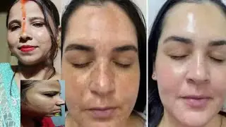 झाइयाँ और धब्बे होंगे ज़ीरो I पिग्मेंटेशन का सबसे असरदार इलाज I Pigmentation Removal 100%