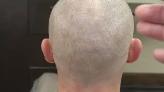 FUE Donor Area Scar Explained | Over 1 Year After Hair Transplant
