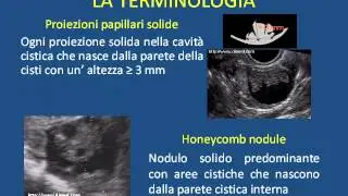 Aspetti ecografici dei tumori borderline dell'ovaio   relazione completa