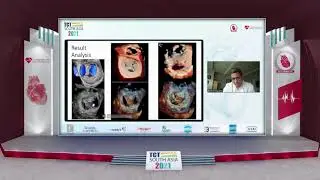 TCT 2021 | Mitral Valve & TV Interventions | Dr Sameer Kapadia | Arena 2 - Day 1