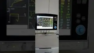 auto peep