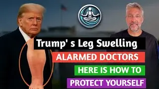 Trump&rsquo;s Swollen Ankles? Venous insufficiency explained | CVI Symptoms and teatment | Wise Health