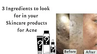3 ingredients to look for in your skincare products for Acne #shorts #acneproneskin #acnetreatment