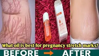 What oil is best for pregnancy stretch marks? Bio Oil for stretch marks 🌟Honest Review🌟