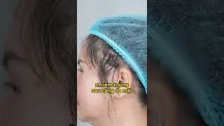DEEP PLANE FACELIFT complications!
