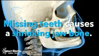 Missing teeth causes a shrinking jaw bone. The best solution is at Impact Dental in Sioux Falls 60