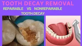 DENTAL CARIES REMOVAL PROTOCOLS TO FORM CAVITY | HOW MUCH DECAY TOOTH REMOVED FOR TOOTH FILLING