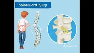 The Spinal Cord Injury and Asia Scale SCI Asia Scale