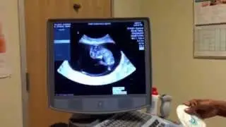 10 WEEKS PREGNANT! BABY KICKING UP A STORM!