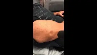 Arctic Blast Cryo - Spot Cooling Cold Therapy Demo With Zimmer MedizinSystems Cryo