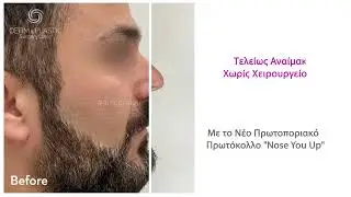 &Upsilon;&alpha;&lambda;&omicron;&upsilon;&rho;&omicron;&nu;&iota;&kappa;ό &sigma;&tau;&eta; &Mu;ύ&tau;&eta; &Pi;&rho;&iota;&nu; &kappa;&alpha;&iota; &Mu;&epsilon;&tau;ά - &Alpha;&nu;&alpha;ί&mu;&alpha;&kappa;&tau;&eta; &Rho;&iota;&nu;&omicron;&pi;&lambda;&alpha;&sigma;&tau;&iota;&kappa;ή  #nosejob #nonsurgicalrhinoplasty