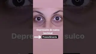 Tipos de olheiras!