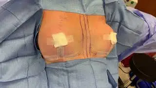 Breast Lift with Implant Downsizing Using Motiva Implants- Before and After!