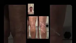O que &eacute; Escleroterapia com espuma?