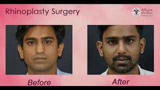 Happy Patient Testimonials about Rhinoplasty:Crooked Nose Reshaping Surgery by Dr. Milan Doshi