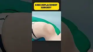 Knee replacement surgery#knee#replacement #medicalworld #surgery #invasiveprocedure #shorts