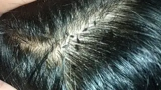 Nits removed ASMR mother removed son lices nites removed 😅