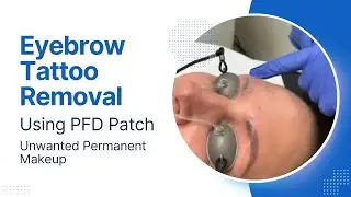 Eyebrow Tattoo Removal | Using PFD Patch | Unwanted Permanent Makeup | Dr. Jason Emer