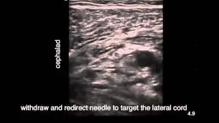 Parasagittal Infraclavicular Block (In Plane Needle Approach With Hydrodissection)