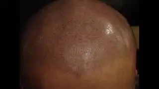 3d Scalp Micropigmentation training - Chris an Artists Artist