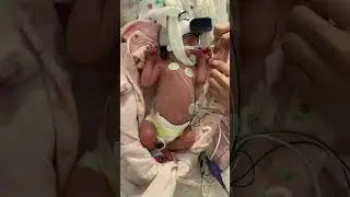 Mom Dresses Premature Baby in NICU on CPAP 💜 #preemie #cute