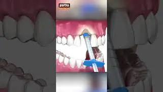 Rebuild Your Jawbone with Bone Grafting at Partha Dental