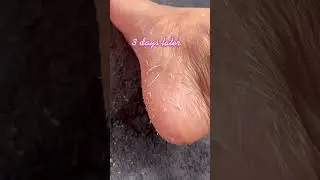 How to remove dead skin on feet #skincareroutine #peeloff  #feetmatter #pedicure #shortfeed