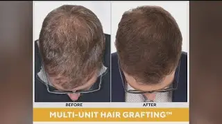 Transitions Indy can help with your hair loss