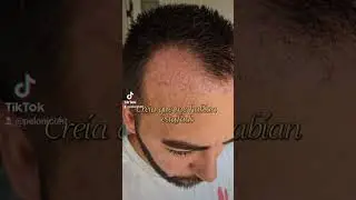 #injertocapilar #hairevolution #trasplantecapilar