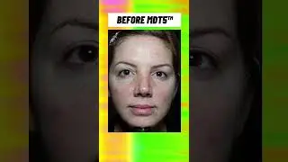 MDT5&trade;: Before & After