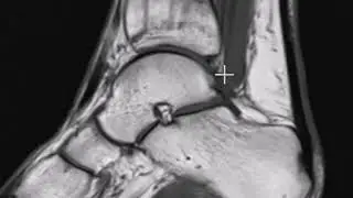 Stress fracture of tibia in runner
