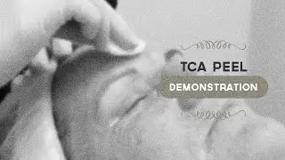 Демонстрация пилинга 35% TCA