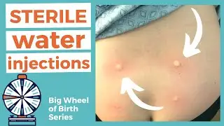 STERILE WATER INJECTION for Back Labor