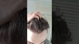 Dr.Kaan Pekiner - 2704 graft FUE - Risultato a 2 anni