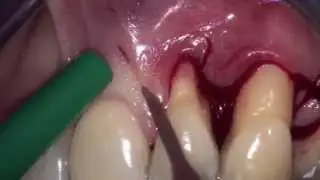 Guided Tissue Regeneration