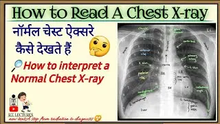 How to read a chest x-ray || Normal chest x-ray interpretation || चेस्ट PA ऐक्सरे कैसे देखे Chest-PA