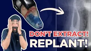 Before You Extract: Intentional Replantation in Practice - PDP256