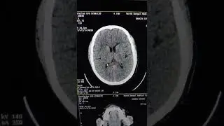CT Scan View.......#hospital  #neurosurgeon #followers