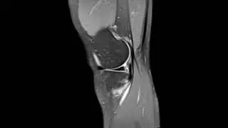 Semimembranosus tendon tear