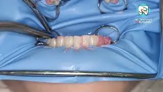 تبيض الاسنان بالديود ليزر     teeth whitning by diode leaser