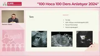 Endometriyal Polip - Doç.Dr. Sabri Berkem Ökten