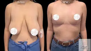 Redukcja z podniesieniem piersi bez implant&oacute;w / Breast Reduction with Lift - No Implants